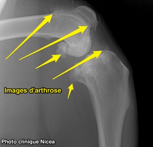 rupture ligament croisé - arthrose