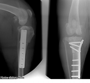 rupture ligament croisé - TWO